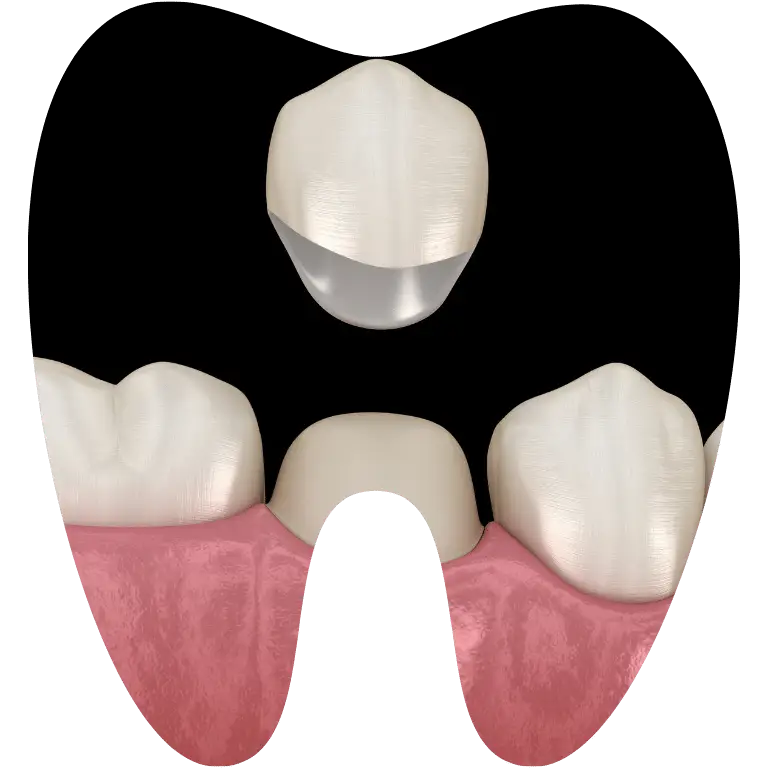 Boc-rang-su-phuc-hinh