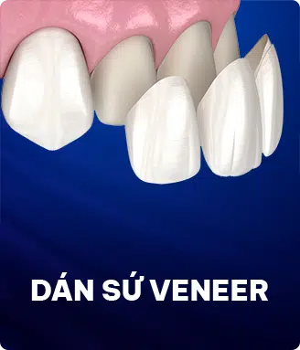 dan-su-veneer